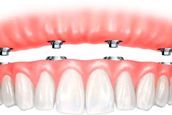 implantes-sobre-dentadura